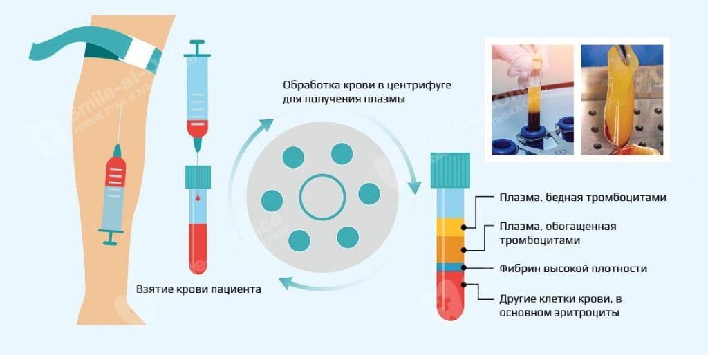 Этапы плазмолифтинга